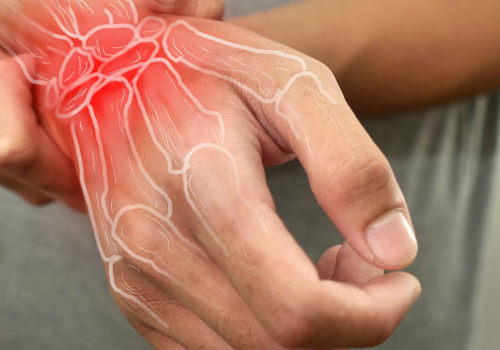 Arthritis